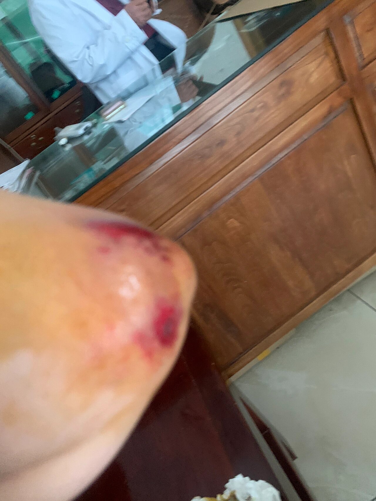 骑电单车摔倒,把手臂,膝盖磕破皮了