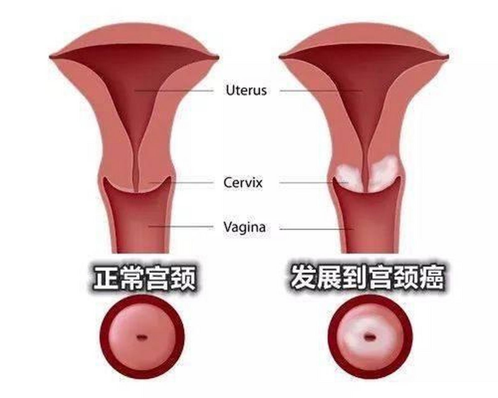 宫颈癌在哪个位置图片图片