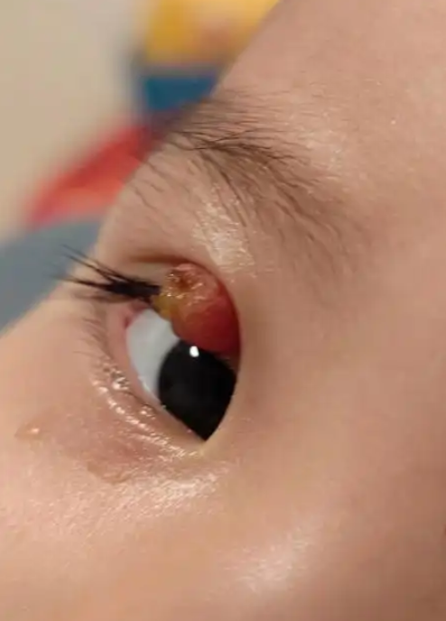 如果霰粒肿长在眼皮里面,可以试试热敷,药物或手术治疗