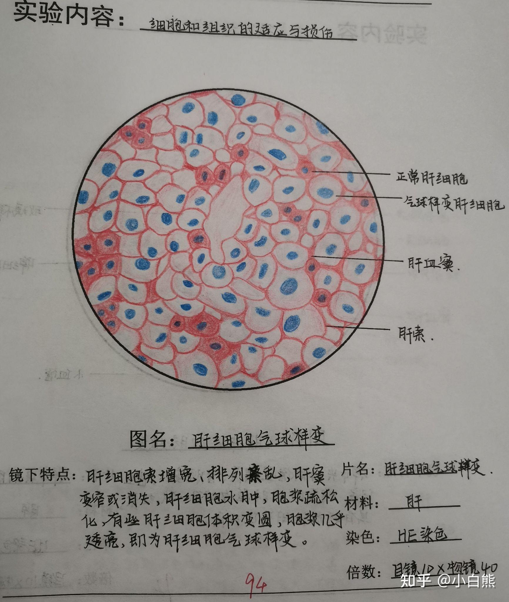 乙脑病理红蓝铅笔图图片