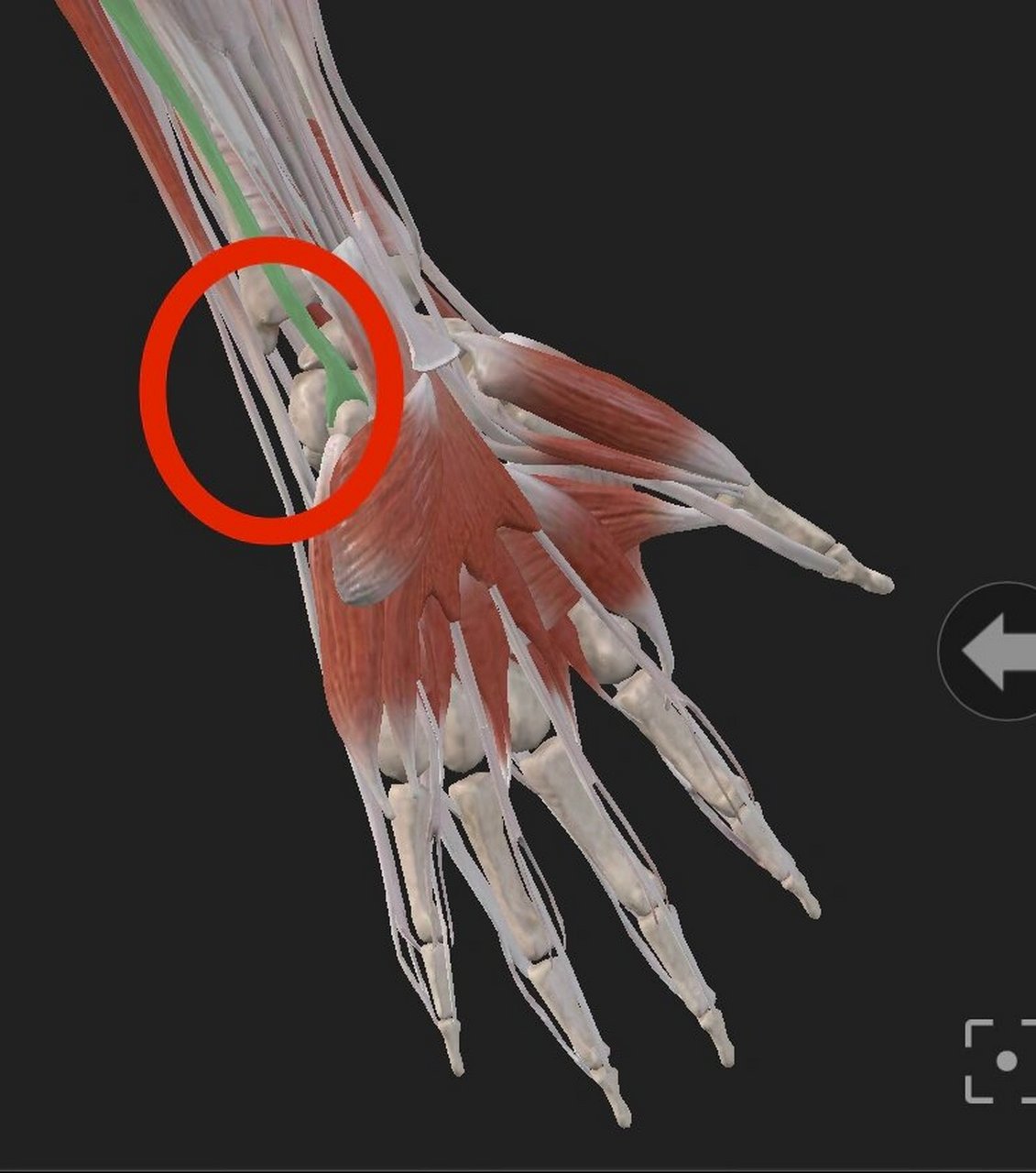 尺侧腕关节疼痛自我治疗 晨起不知原因右手尺侧腕关节疼痛,尺偏,桡偏