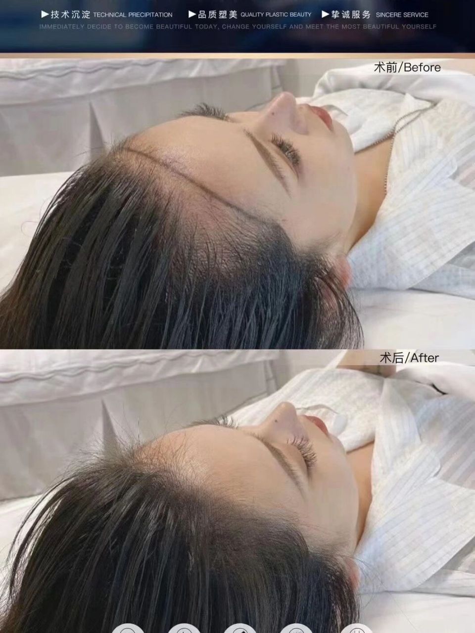 植发 ——————— 女士植发案例对比 发际线降低,颅顶增高后 完全