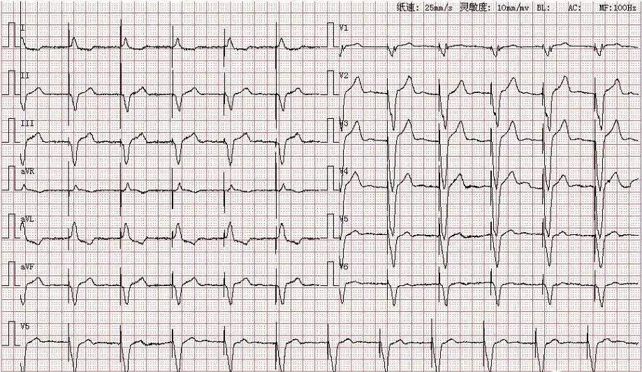 心室起搏心电图特点图片