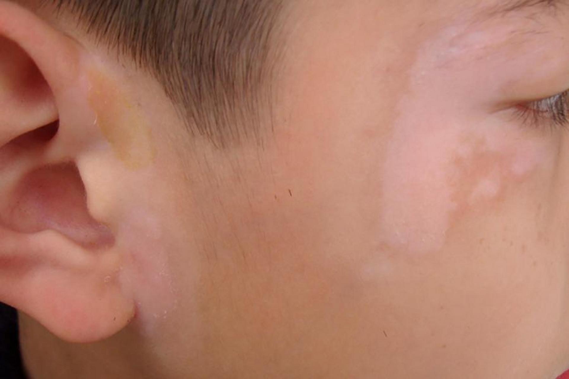 孩子脸上有一块一块的白斑还覆有细糠状的鳞屑是怎么回事?