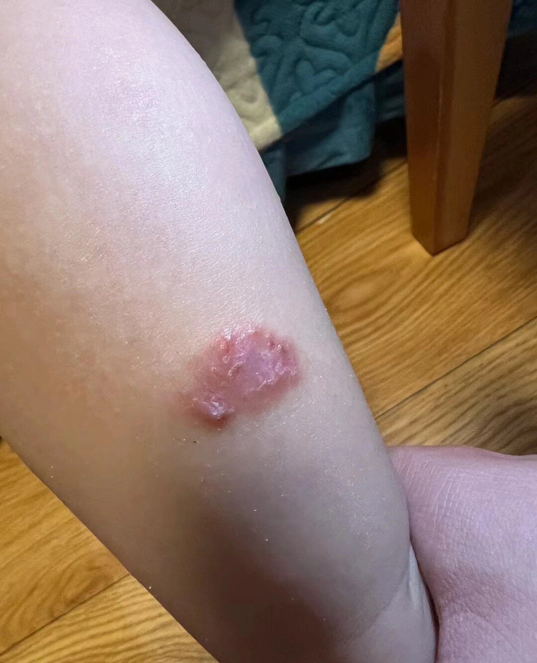 小朋友腿上的湿疹