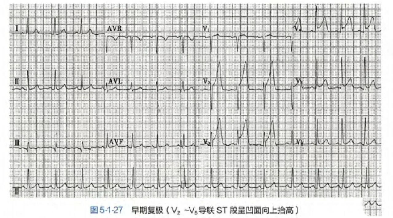 心电图等电位线是死了图片