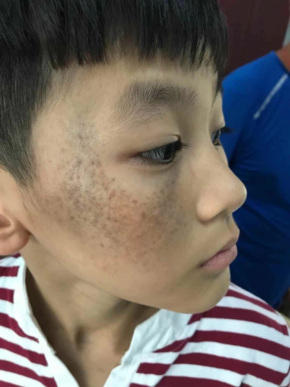 胎记祛除中,这是太田痣,常见于面部及眼部  这是太田痣,看起来就像黑