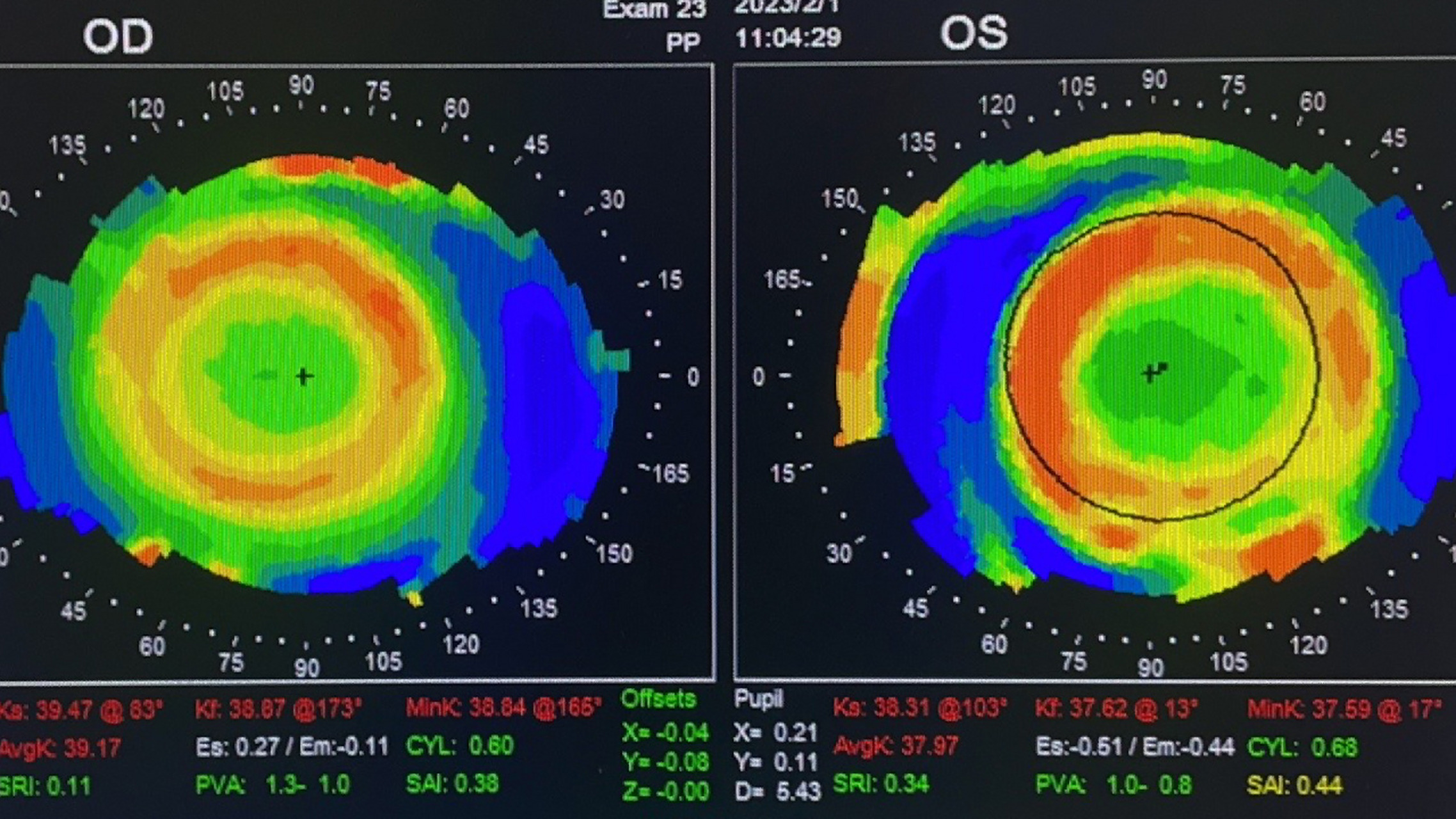 今天我们就来详细的了解下角膜地形图 首先我们来给大家讲一下