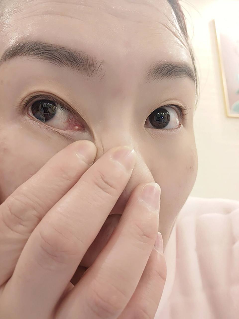 眼角长肉粒 眼角这里长了颗肉粒,不知道什么时候长的.