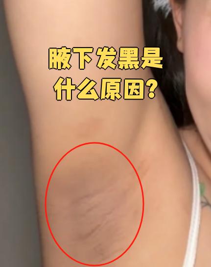 腋下发黑常见原因包括黑棘皮病,局部慢性炎症和内分泌异常