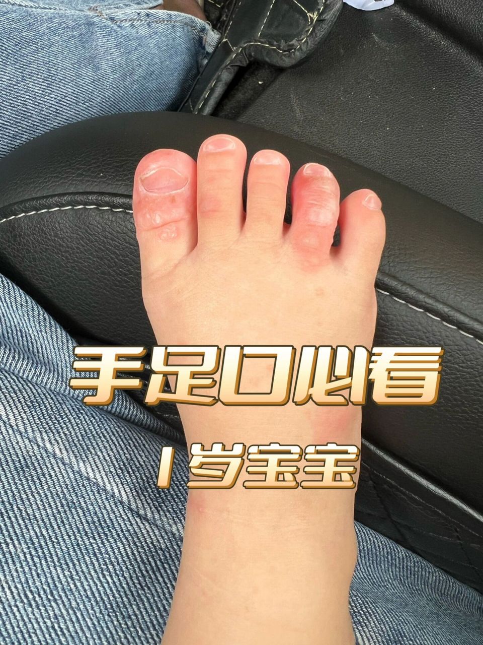 小儿手足口病 婴儿图片