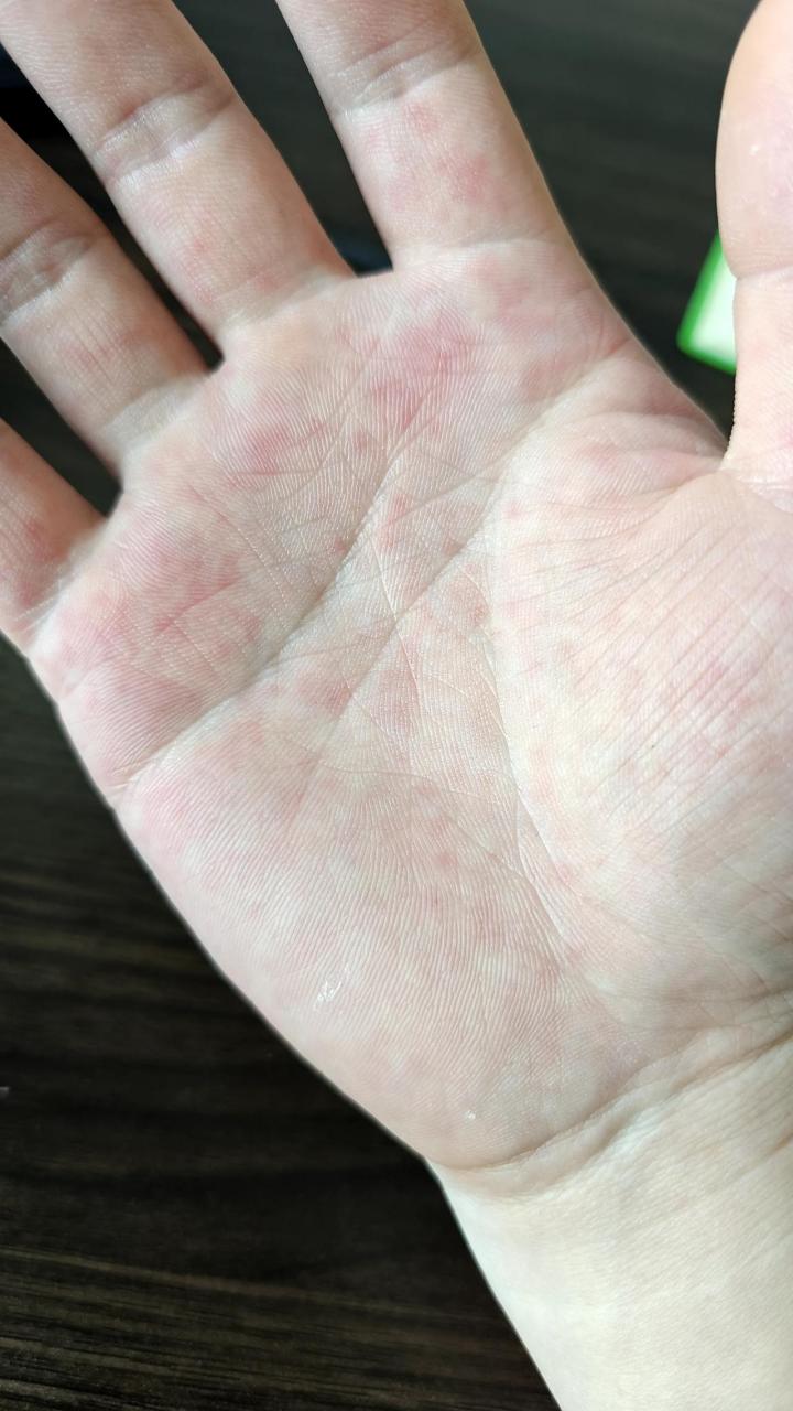手掌心起小红点,按压有轻微刺痛感. 这是什么原因呢?与肾虚有关吗?
