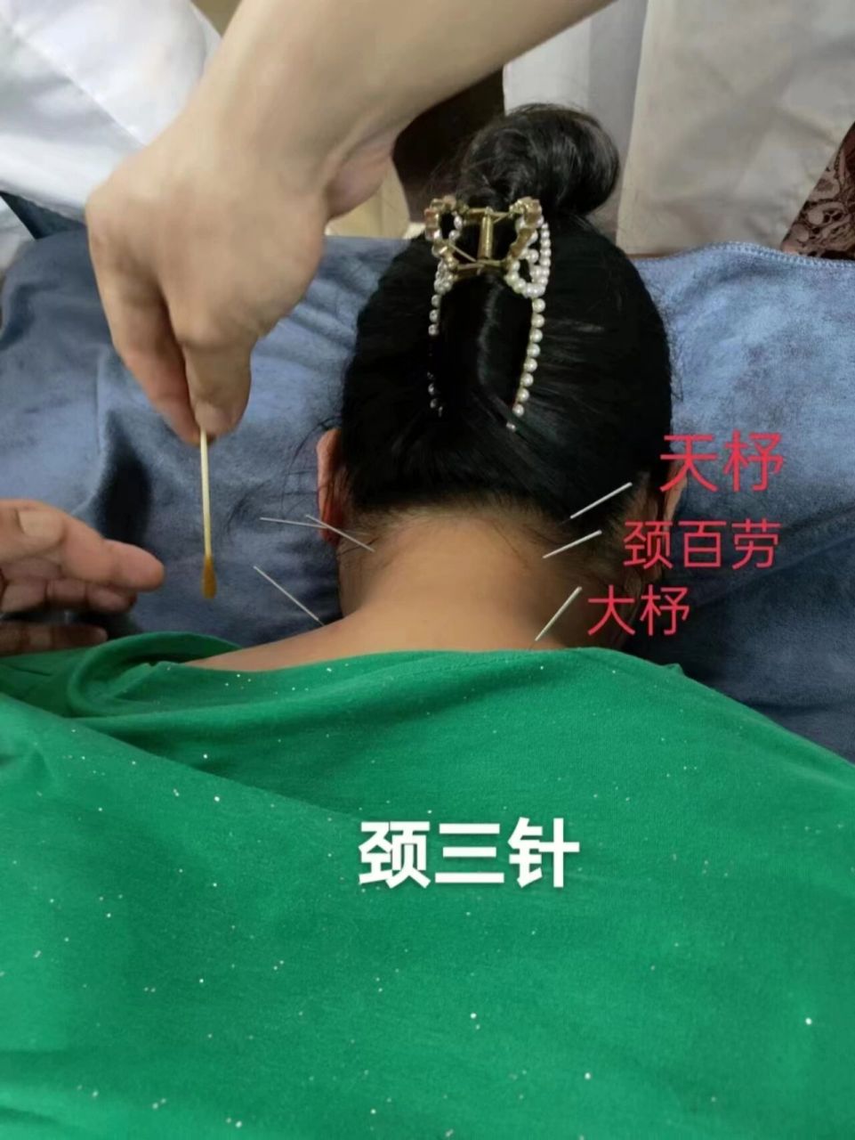 针灸学习:靳三针–颈三针 "颈三针"由百劳,大杼,天柱组成,三穴均位于