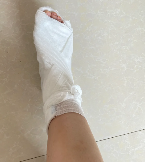 脚崴了轻微骨裂需要打石膏吗?