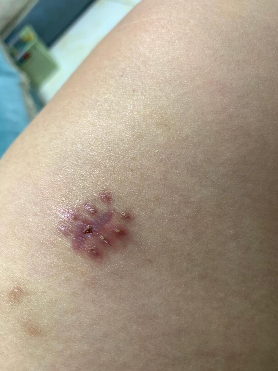 关于 大腿上长个 硬疙瘩 这件事 开始是肉色,大概有小米粒大小,摸着有