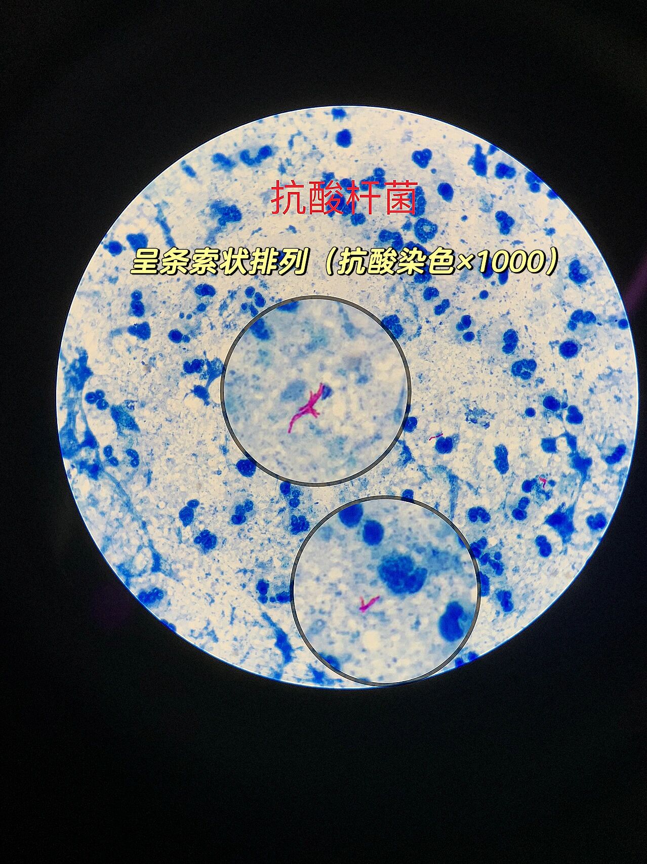 分枝杆菌-抗酸杆菌(acid-fast bacilli,afb) 革兰染色呈阳性,但不易