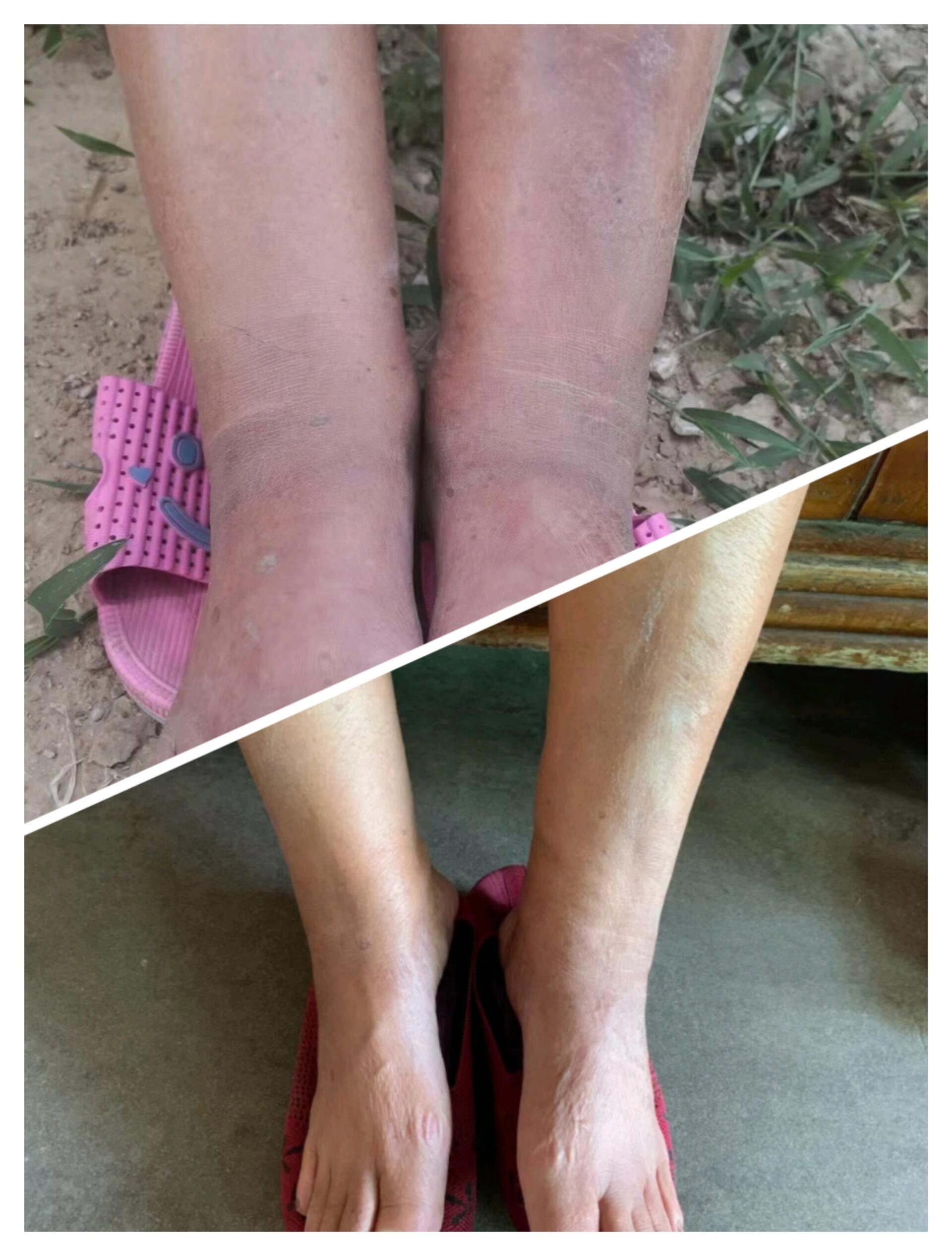 ​下肢严重水肿