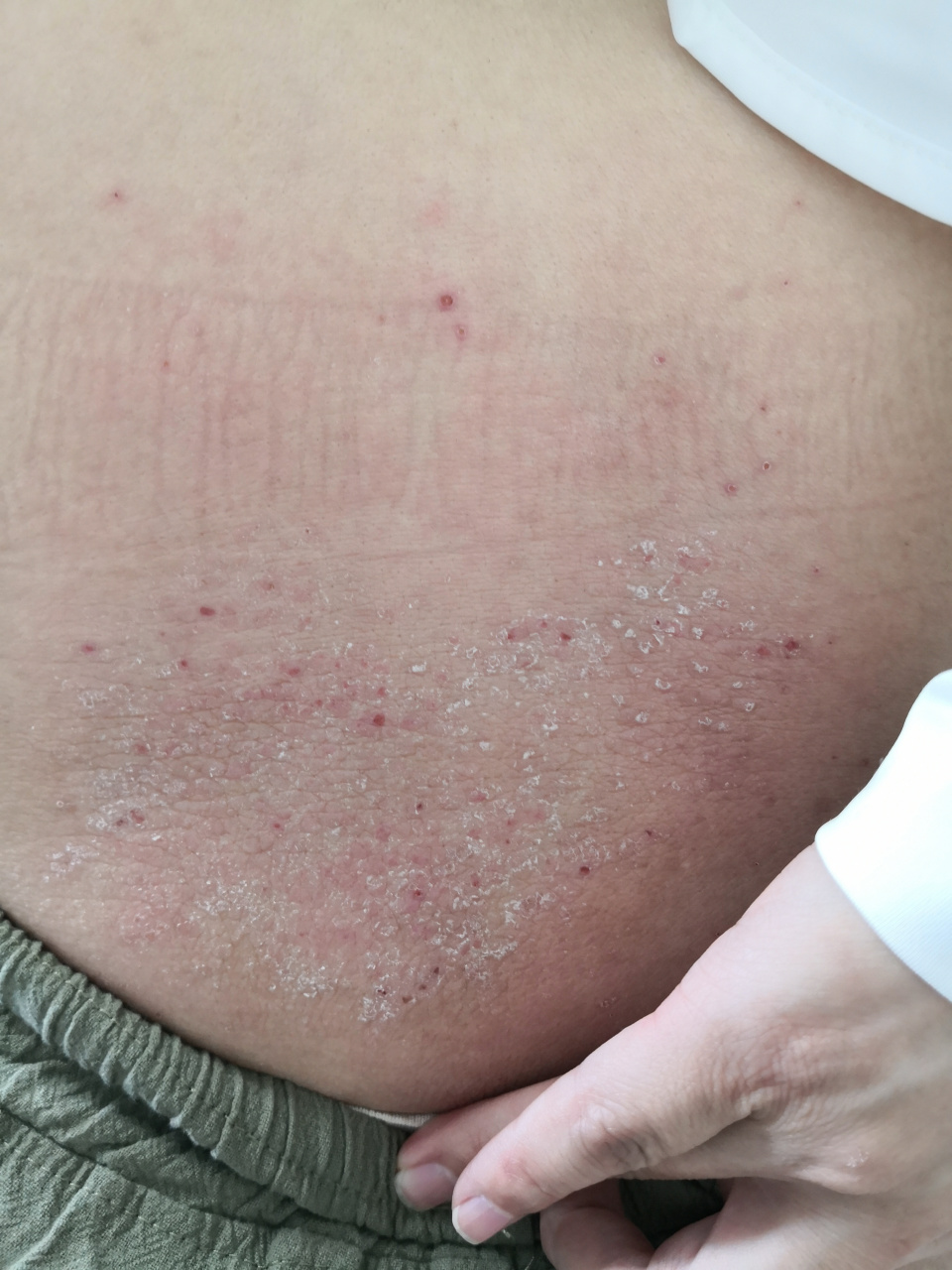 背部干燥脱屑丘疹症状有过敏体质