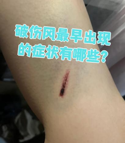 当皮肤被铁锈刺伤或发生开放性骨折时,破伤风杆菌可能从伤口侵入