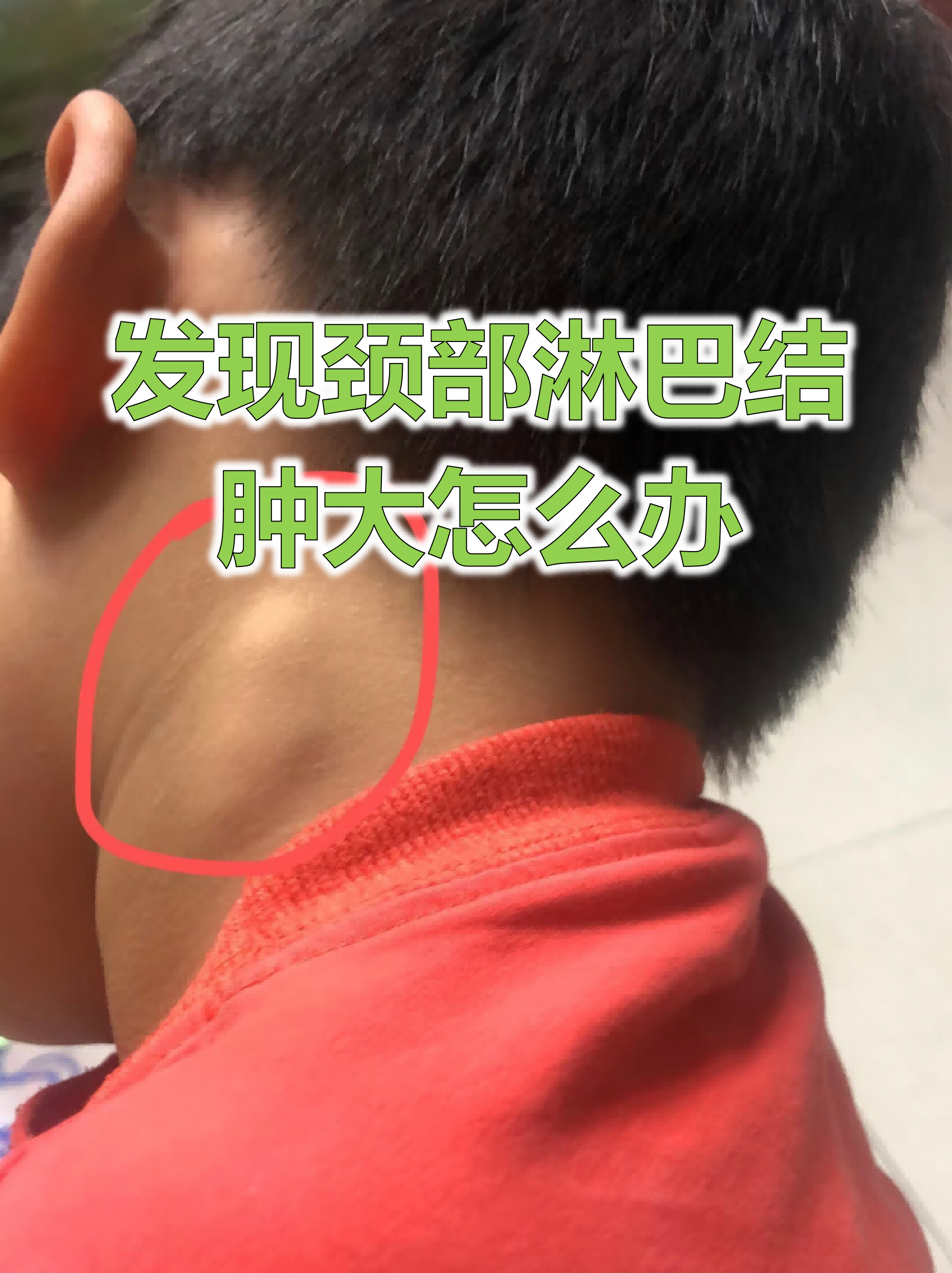 发现颈部淋巴结肿大怎么办