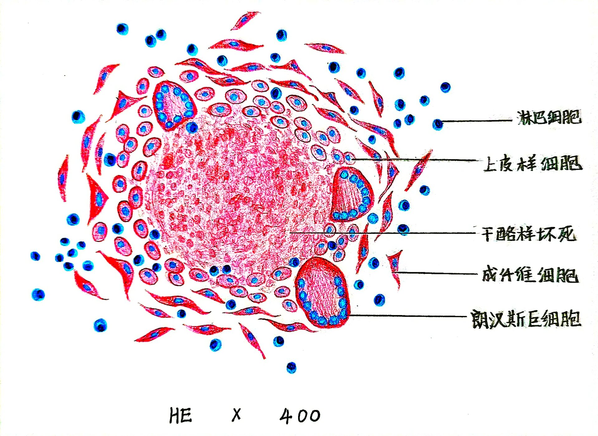 结核结节红蓝铅笔手绘