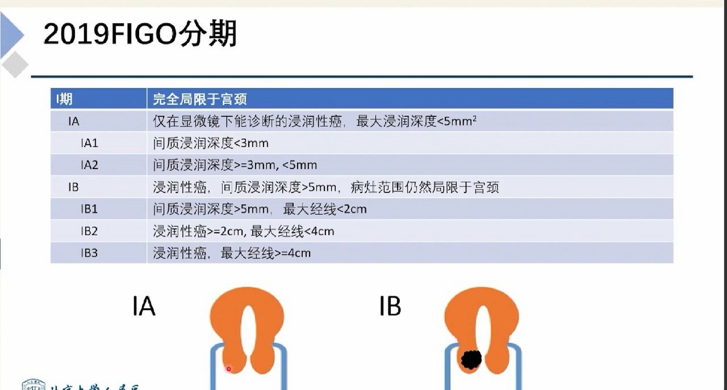 宫颈癌figo分期(一)
