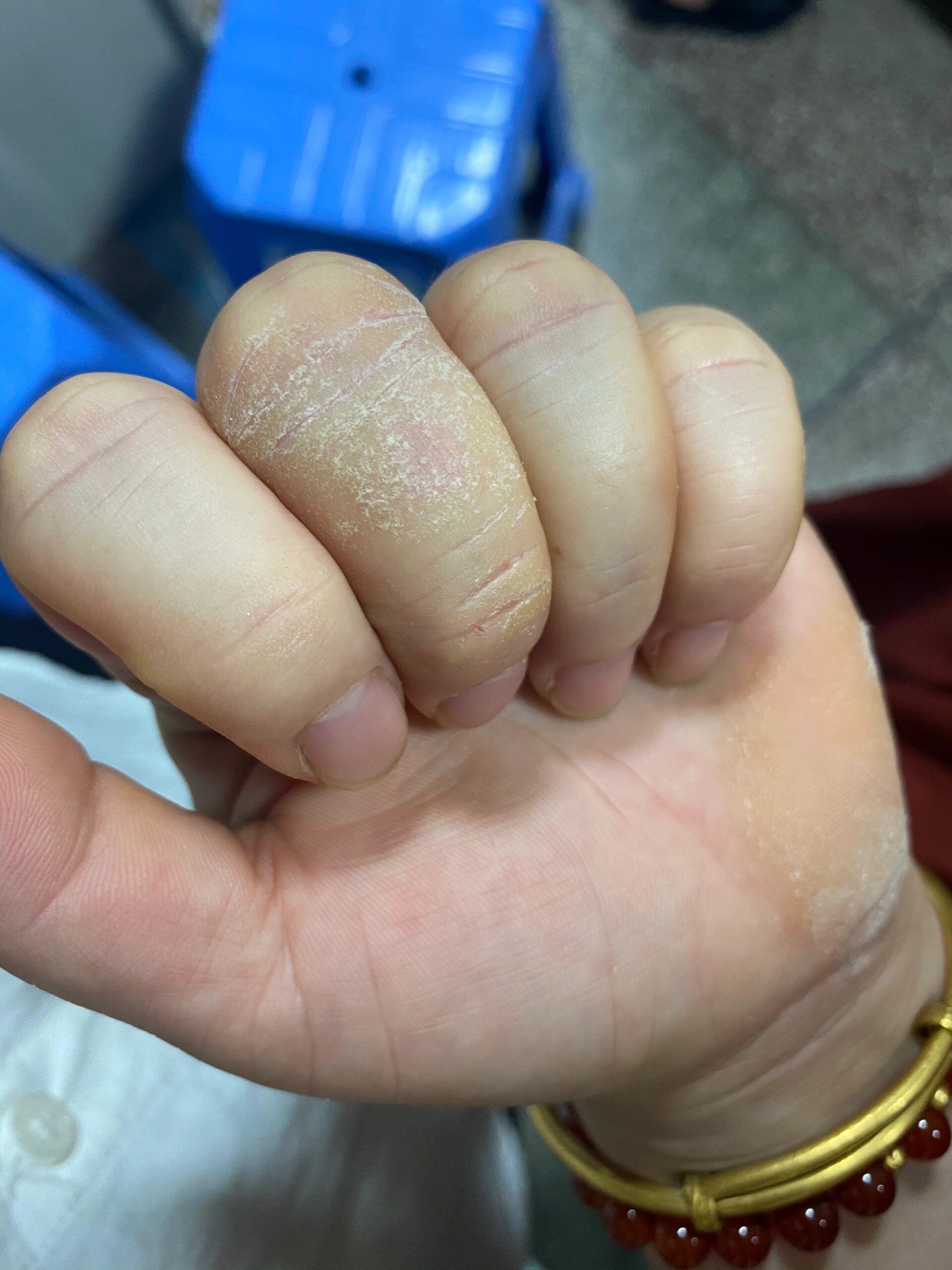 手会突然开裂,最开始是中指第二节开始一点点开裂,手掌那儿也是后来