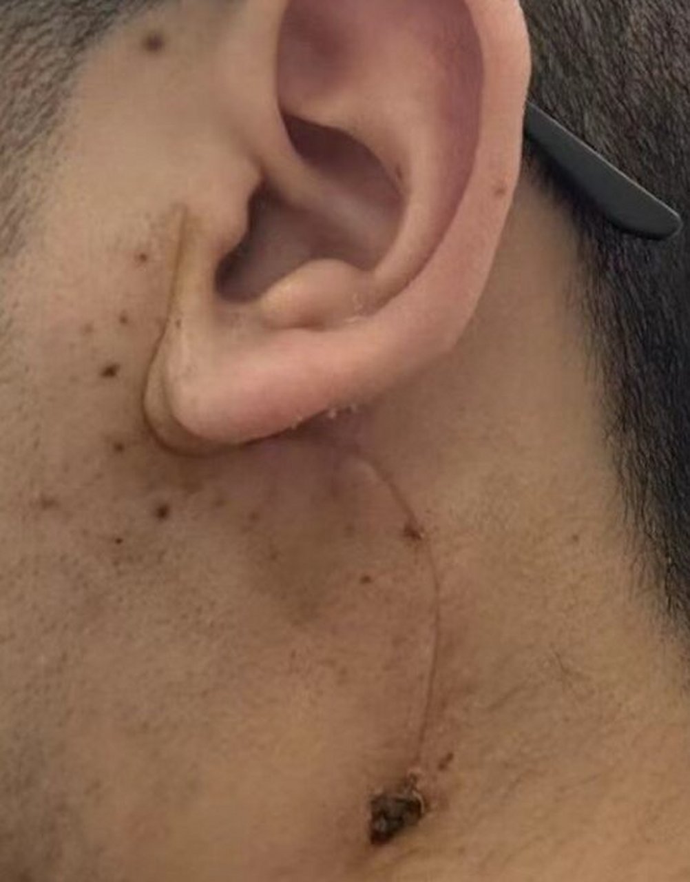 关于腮腺混合瘤手术以及2个月恢复情况 去年6月份时就摸到左脸颊,耳垂