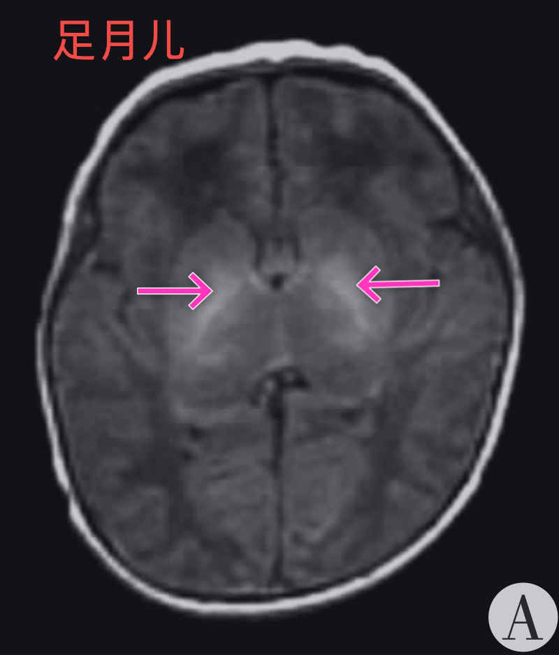 检查中,经常发现双侧苍白球t1加权成像