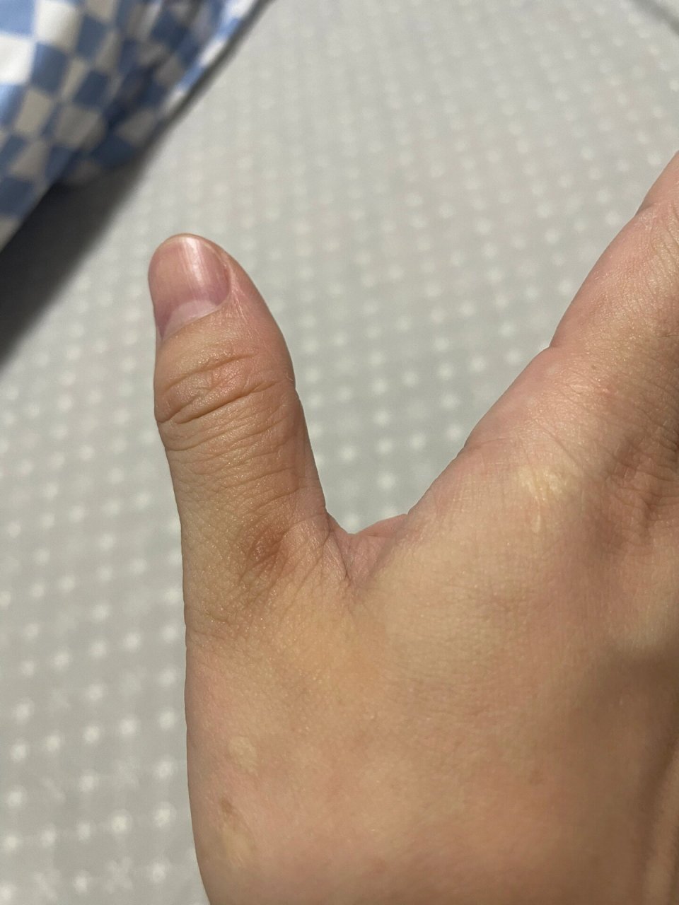 为什么大拇指第一关节那里会黑黑的 右手大拇指第一关节黑黑的,越来越