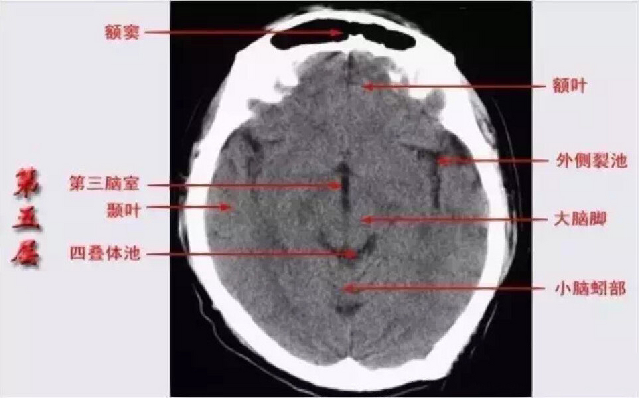 脑干ct解剖图片