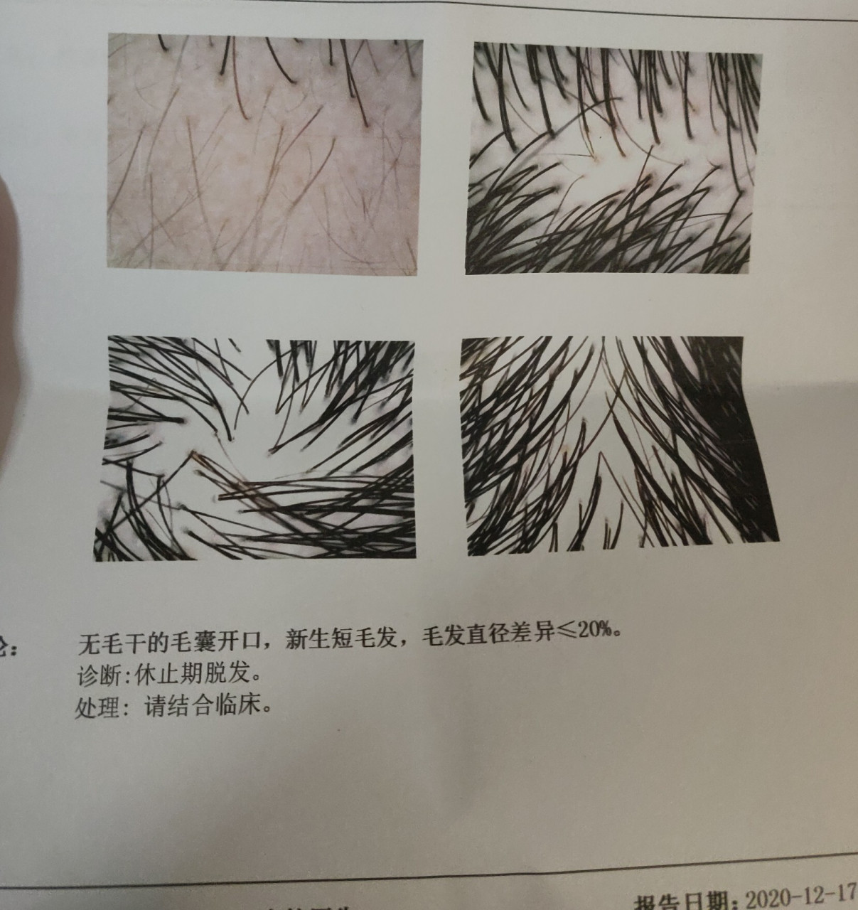 两年治疗脱发,终于结束了 写一篇关于脱发的吧 杨顶权医生(据说国内