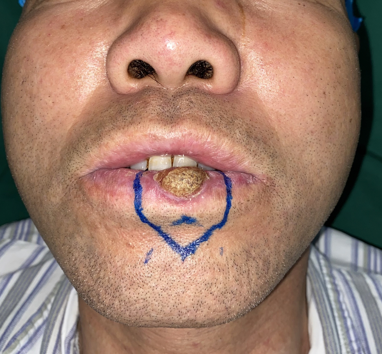 口唇恶性肿瘤,提高认识,提前预防!