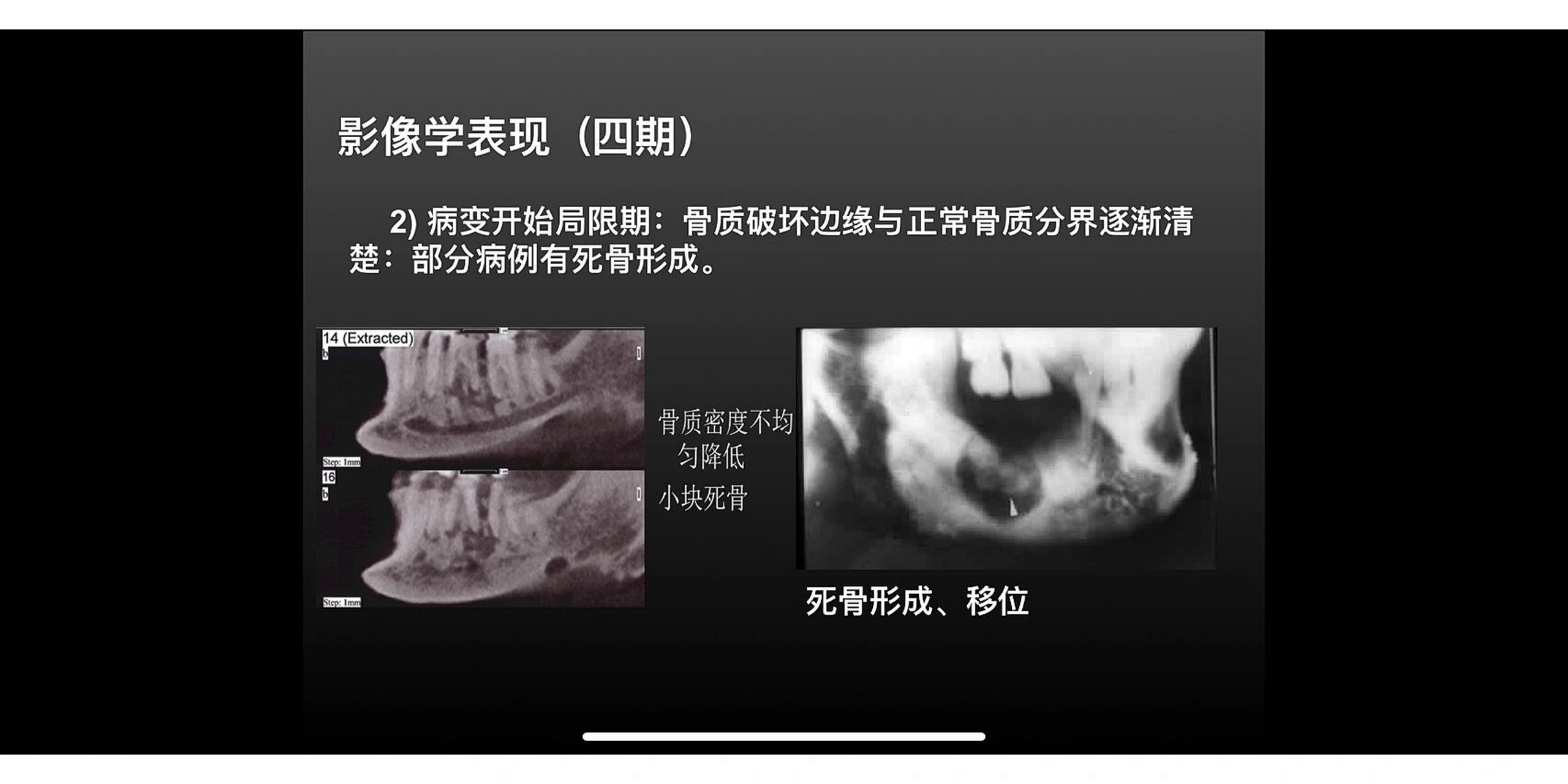 中央性颌骨骨髓炎和边缘性颌骨骨髓炎区别 影像学改变