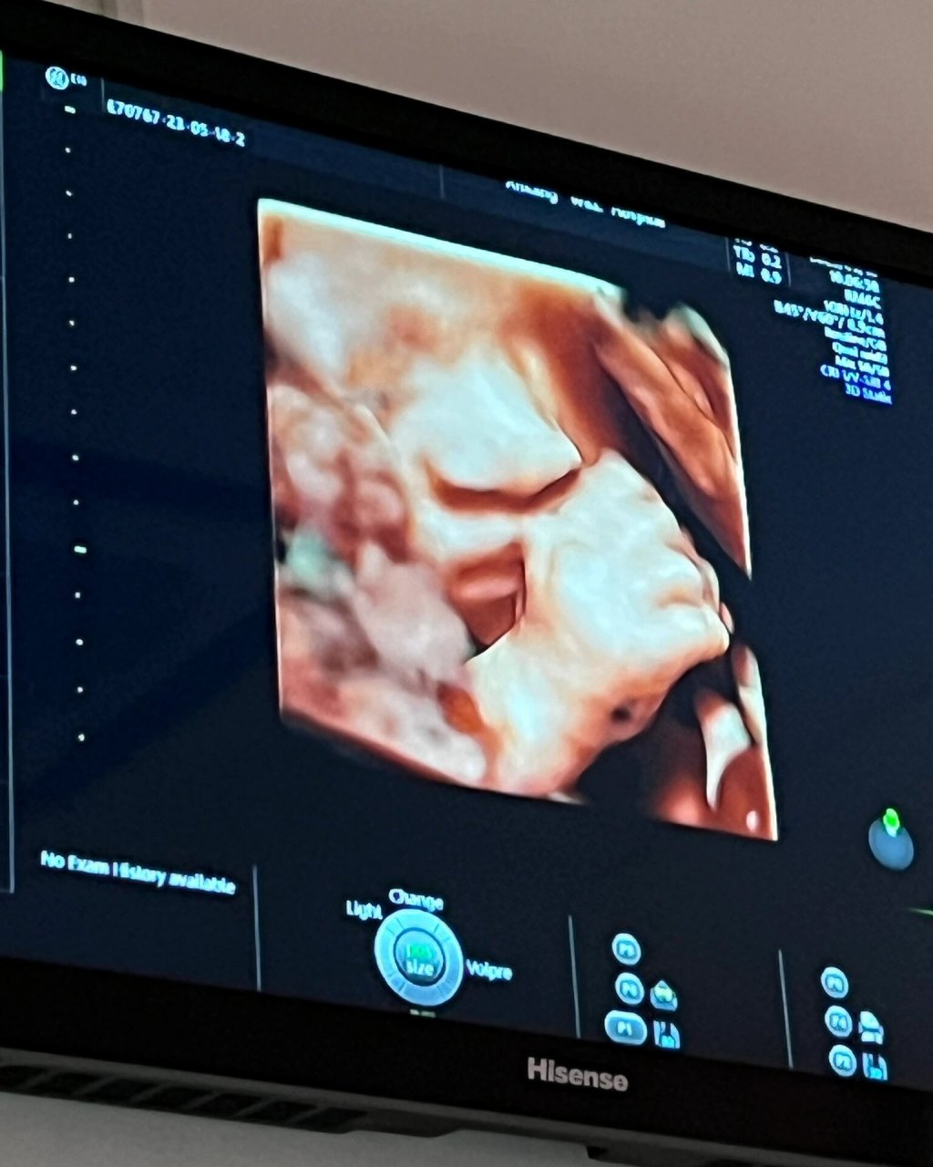 看看你们的四维彩超照片! 98救命为啥我女儿鼻子这么大啊啊啊啊!