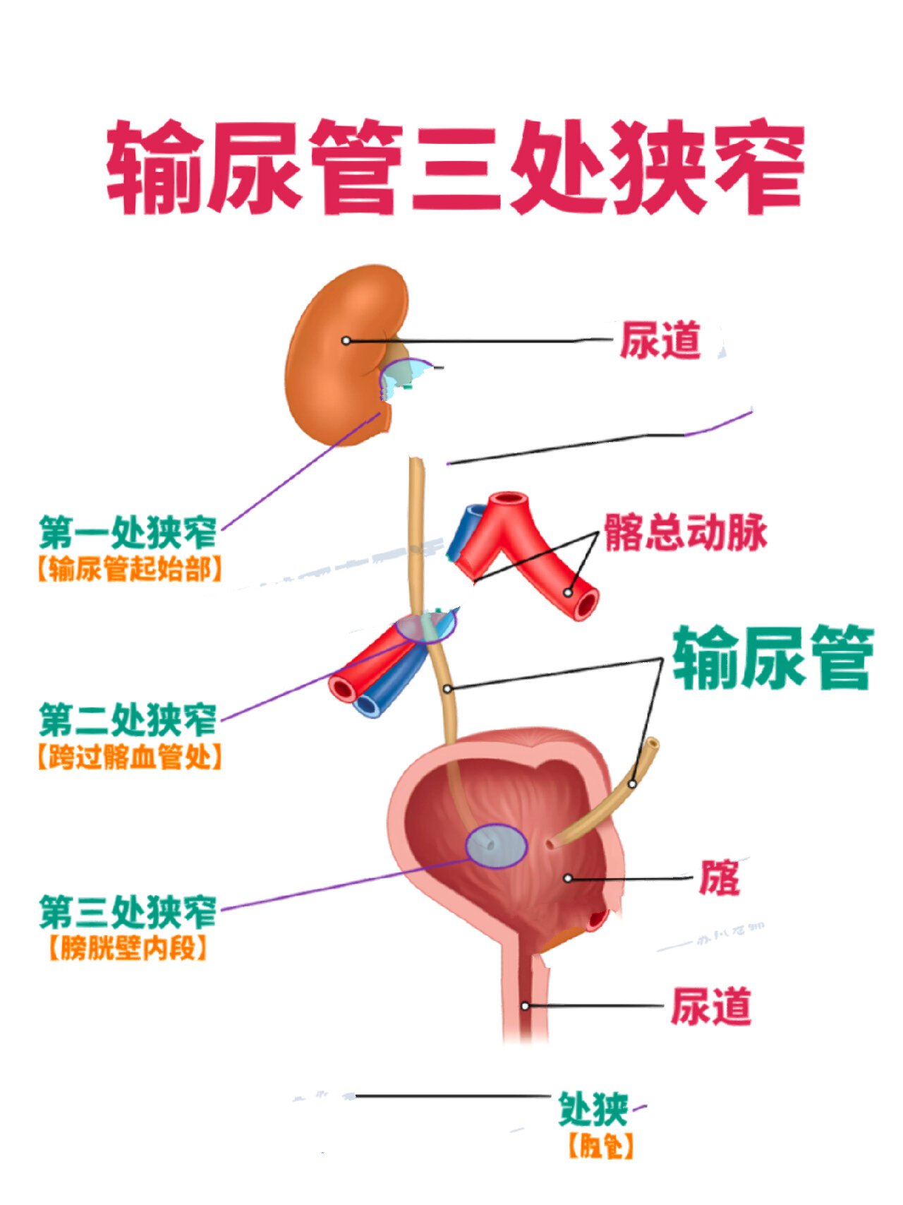 输尿管第三狭窄处图图片