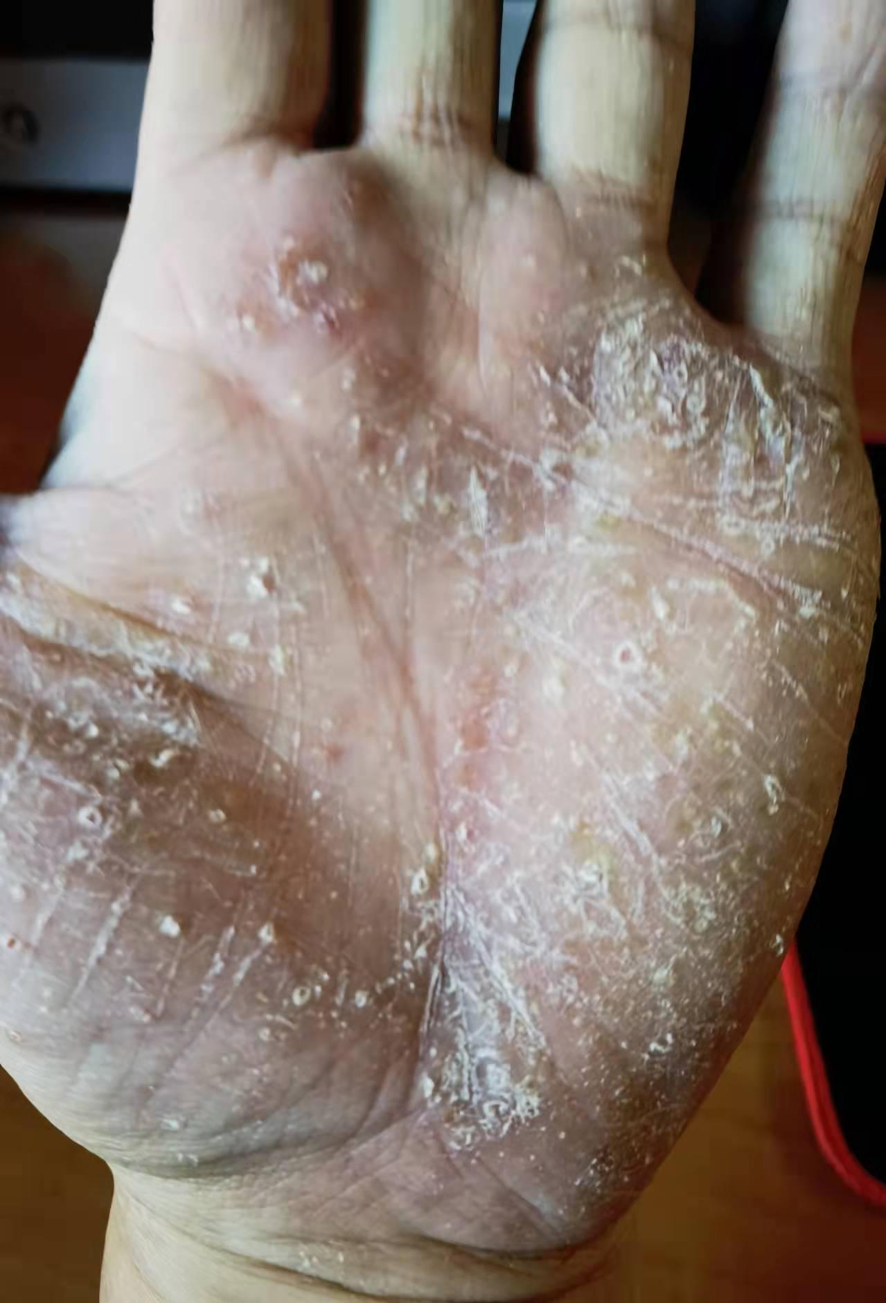 调皮有道李志忠 的想法: 掌跖脓疱病外治法: | 水疱,脓疱较多,选用