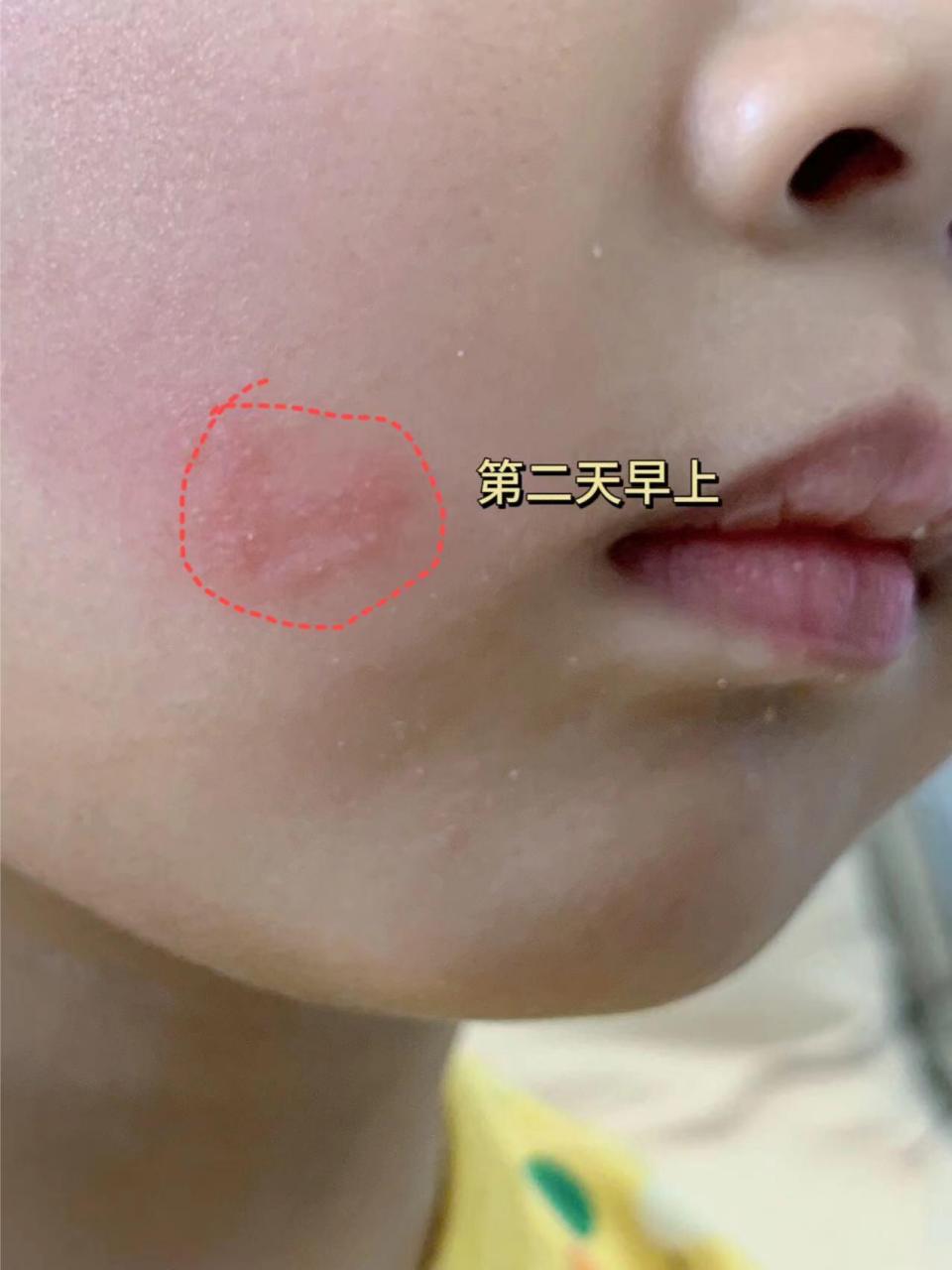 新手妈妈遇见病毒性疱疹彻底崩溃!