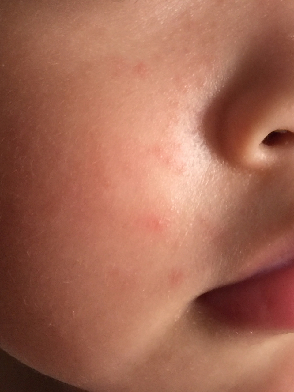 宝宝脸上长小红疙瘩图片