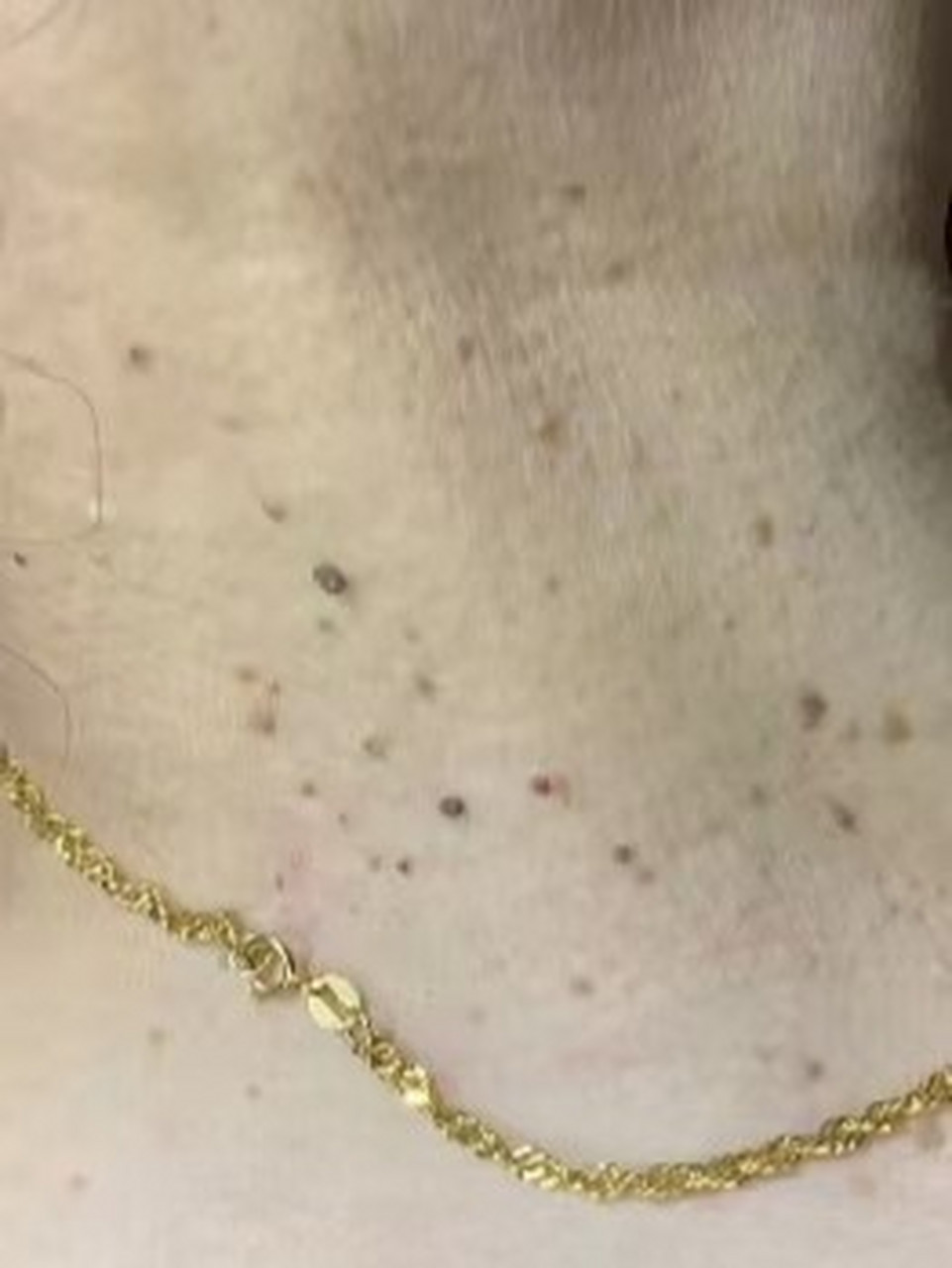 脖子上长了很多小揪揪,其实都是蒂状疣 有很多人脖子上会长这种一颗颗