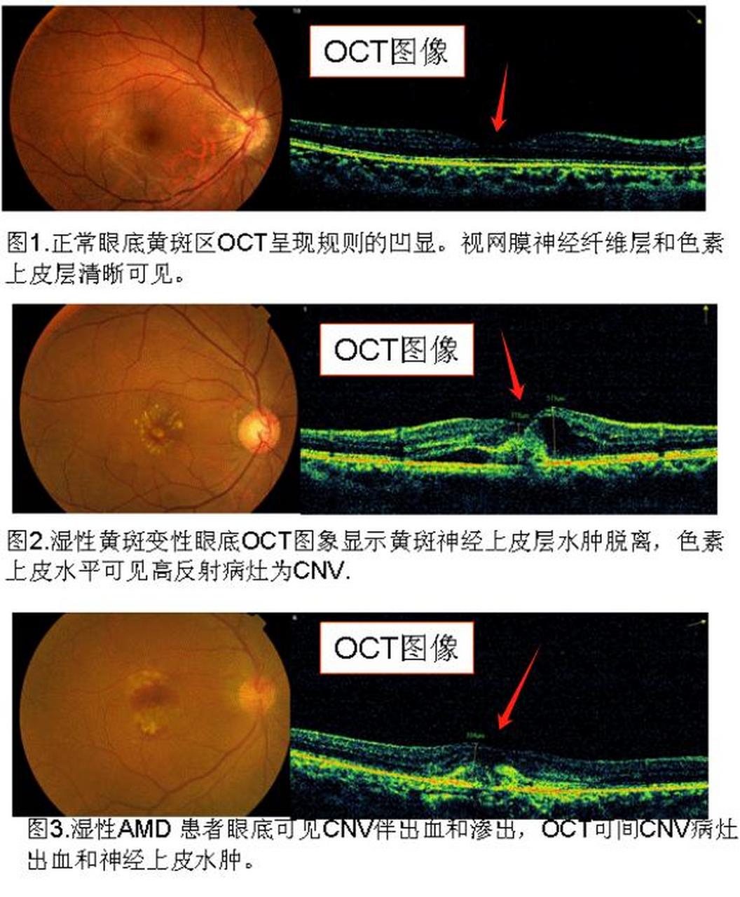 吃了定心丸 黄斑水肿 是可以治疗的   大家好,我是湖北省中医院的眼科