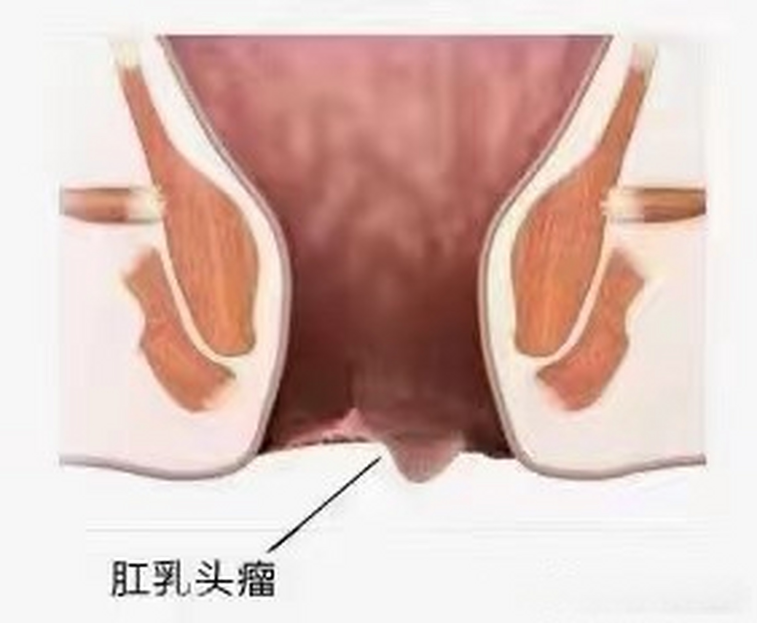 柳州东大肛肠医院##肛乳头瘤# ,又称肛乳头肥大或乳头状纤维瘤,室一