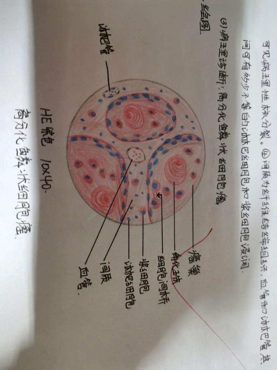 鳞状细胞癌病理绘图图片