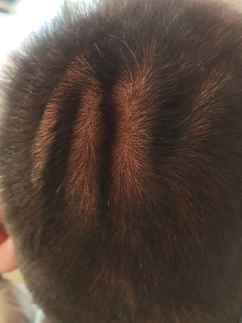 回状头皮.#皮肤病##慢性病