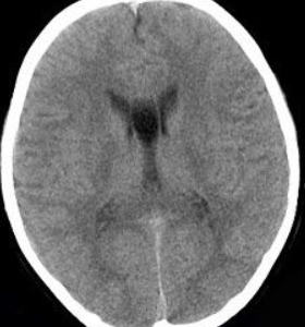 脑内透明隔囊肿是什么意思?