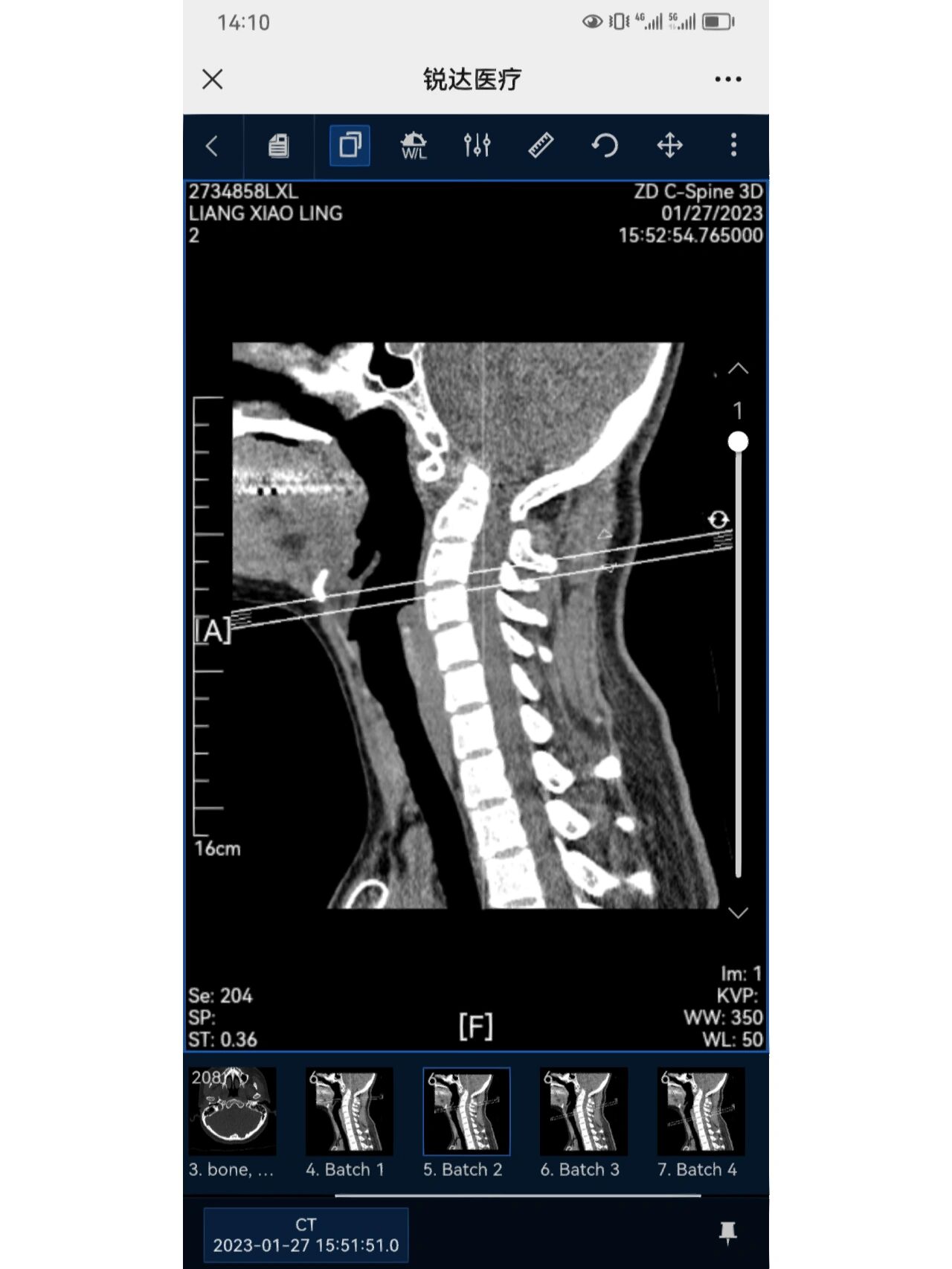 第一次的ct献给了颈椎