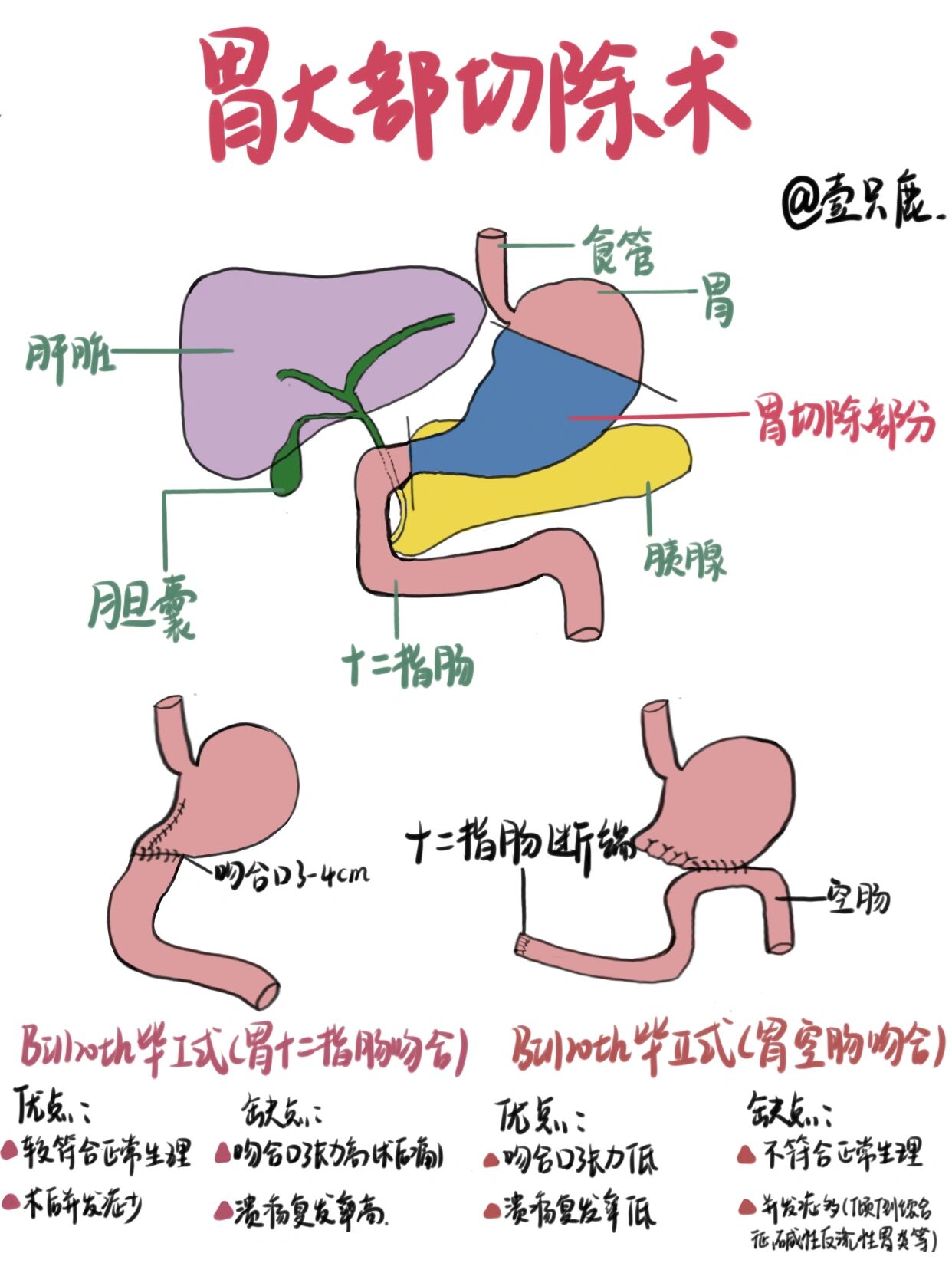 Ⅰ式胃大部分切除术是将远端胃大部分切除以后,将残胃与十二指肠吻合