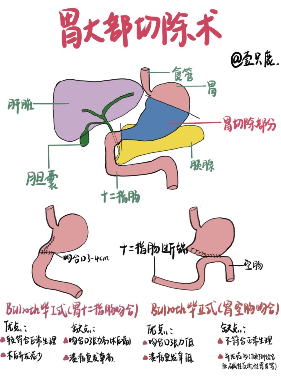 很多宝子们私信说想了解毕Ⅰ式和毕Ⅱ式 毕Ⅰ式胃大部分切除术是将