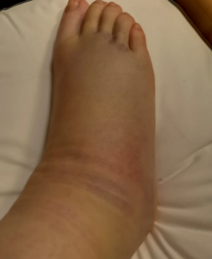 第一远节趾骨骨折通常由运动损伤,过度使用,跌落,骨质疏松症或骨髓