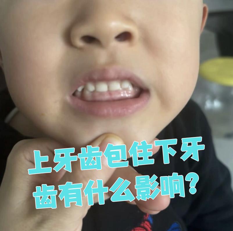 上牙齿包住下牙齿(深覆颌)是一种常见的咬合问题